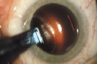 Astigmatic Keratotomy